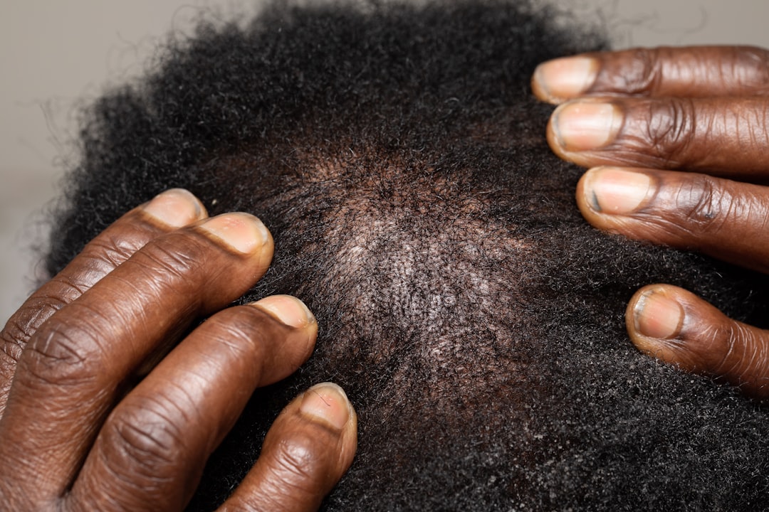 Getatoeëerde haarlijn wordt steeds populairder: duizenden behandelingen per jaar